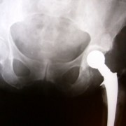 Osteoarthritis related image
